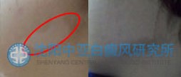 辽宁治疗白癜风哪家医院好 辽宁治疗白癜风哪家医院好